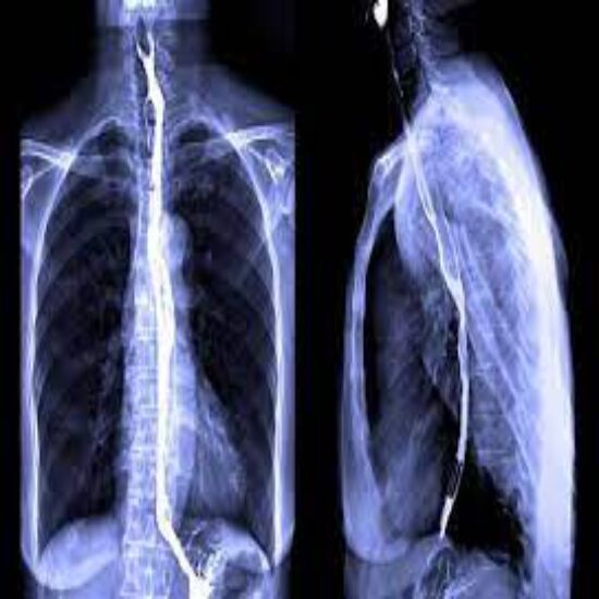 X-ray Barium Swallow
